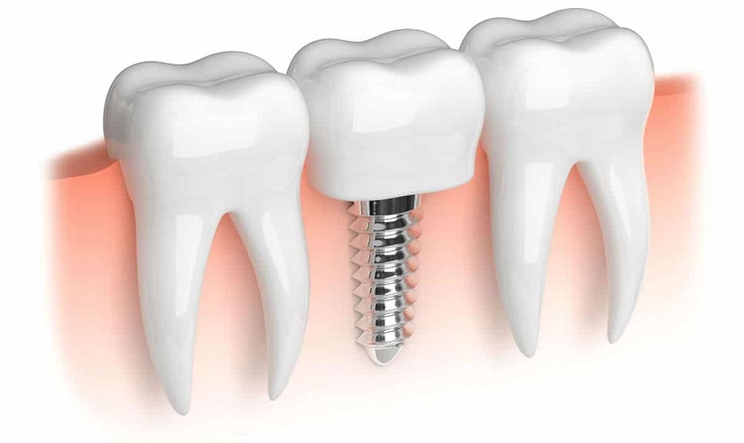 Các loại trụ implant