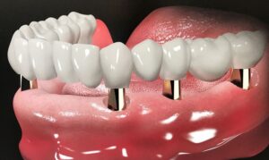 trồng răng implant toàn hàm