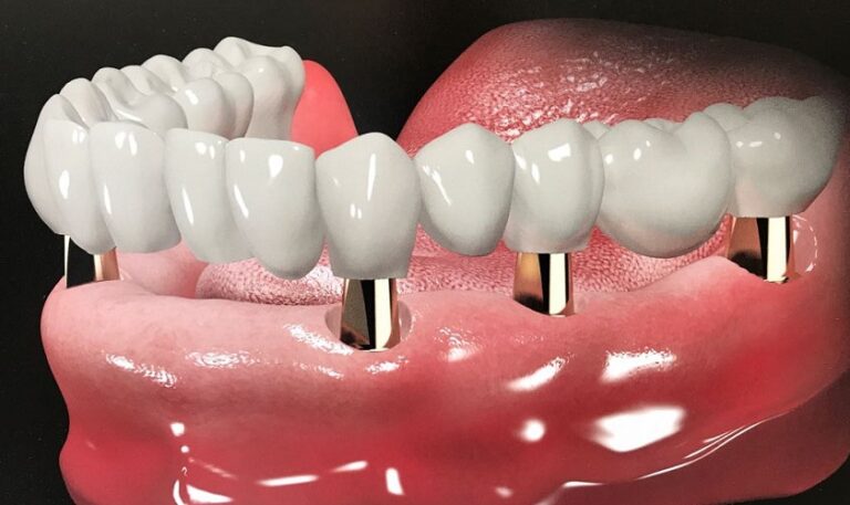 trồng răng implant toàn hàm