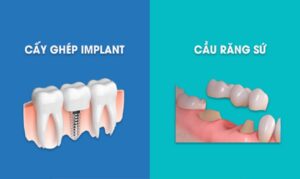 nên trồng răng sứ hay implant
