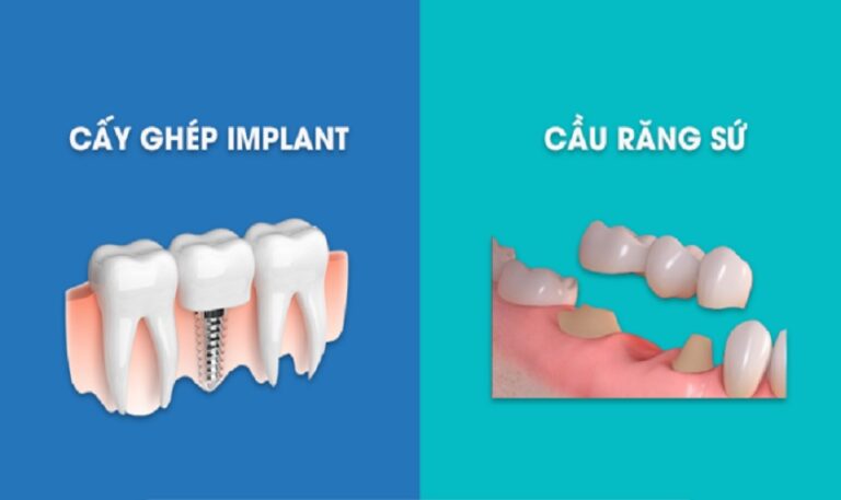 nên trồng răng sứ hay implant