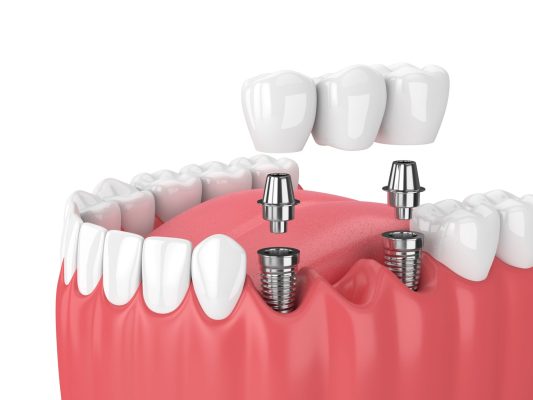 Nha khoa uy tín cung cấp đa dạng các loại trụ implant