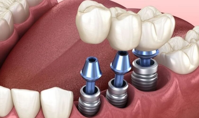 Cấy ghép implant tức thì 