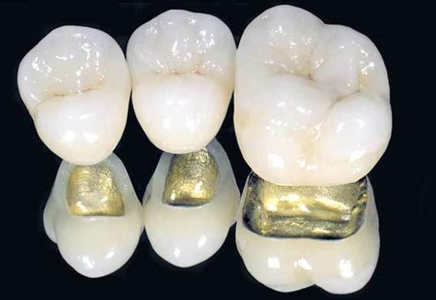 Bọc răng sứ kim loại
