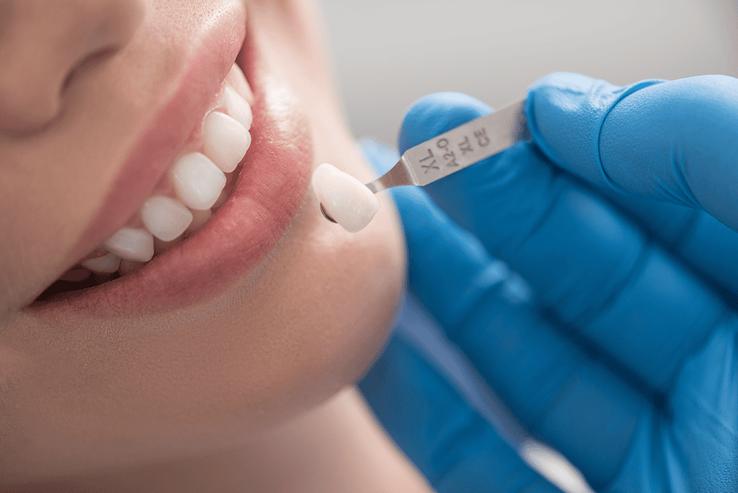 Bọc răng sứ có tẩy trắng được không