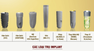 Các loại trụ implant phổ biến hiện nay