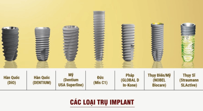 Các loại trụ implant phổ biến hiện nay