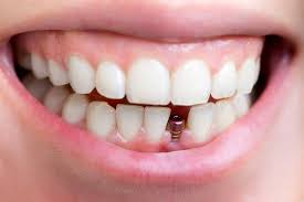 Cấy implant tức thì ngay sau nhổ răng