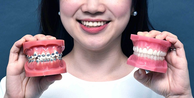 Niềng răng là gì