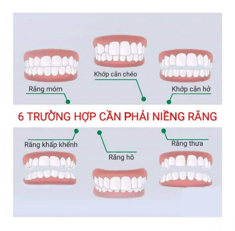 Niềng răng là gì. Các trường hợp nên niềng răng