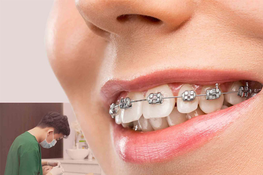 Niềng răng là gì