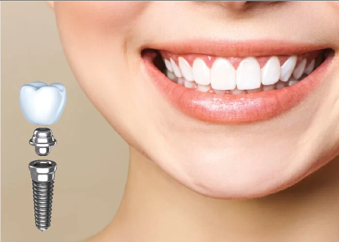 Đánh giá về cấy ghép implant tức thì