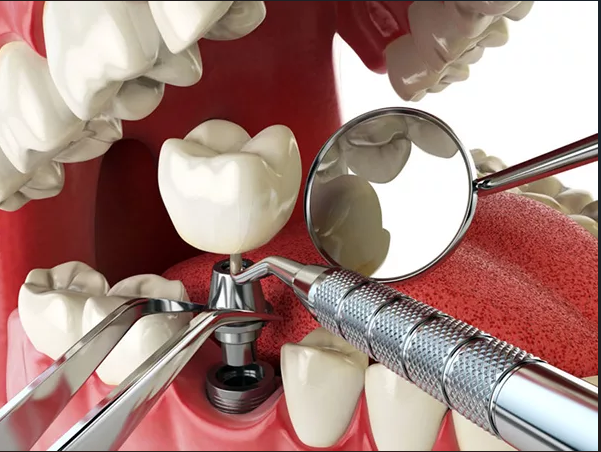 So sánh implant tức thì với implant truyền thống