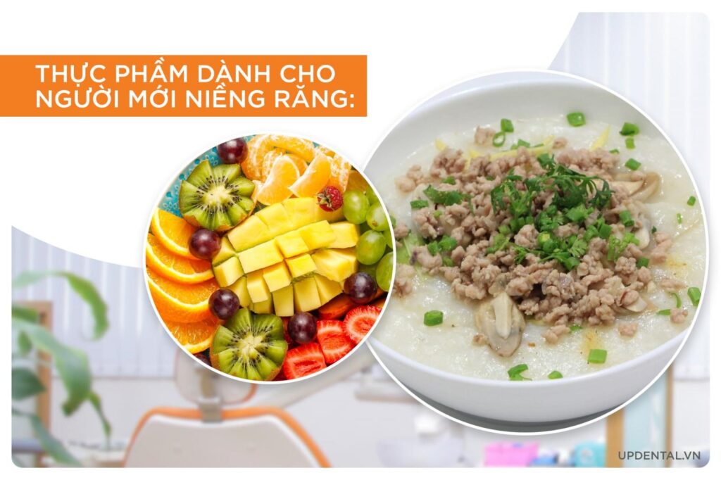 Niềng răng ăn gì?