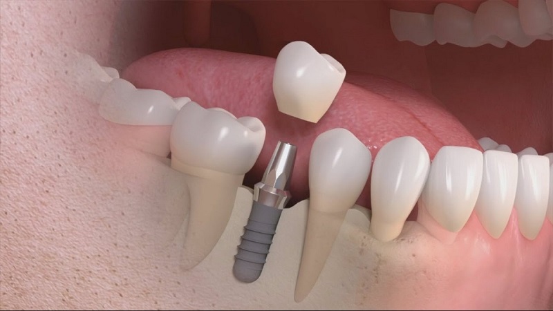 Thăm khám và đánh giá sức khỏe trước khi trồng răng implant cho người già