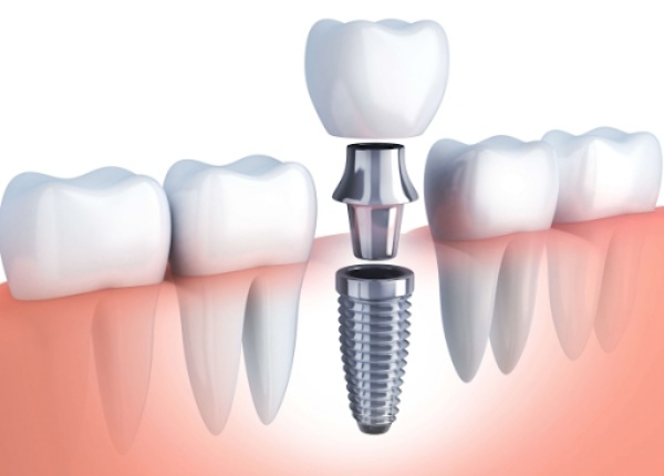 Trồng răng implant có được bảo hiểm không
