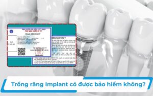 Trồng răng implant có được bảo hiểm không