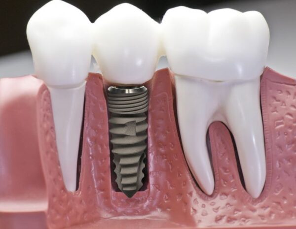 Trồng răng implant có được bảo hiểm không