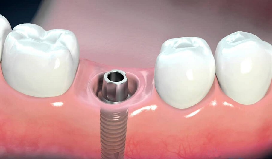Nha khoa uy tín cấy ghép trụ Implant Nobel 