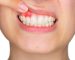 Hậu quả bọc răng sứ kém chất lượng là viêm nướu